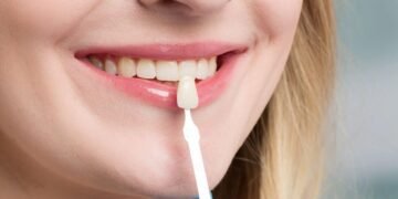 dental veneers