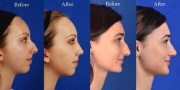 Rhinoplasty