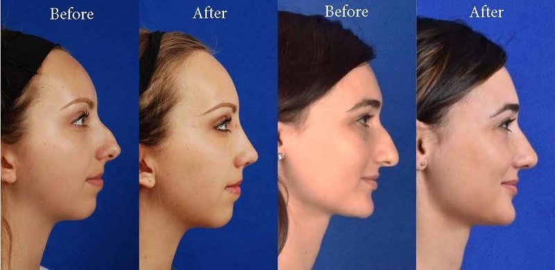 Rhinoplasty