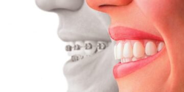 Invisalign Treatment