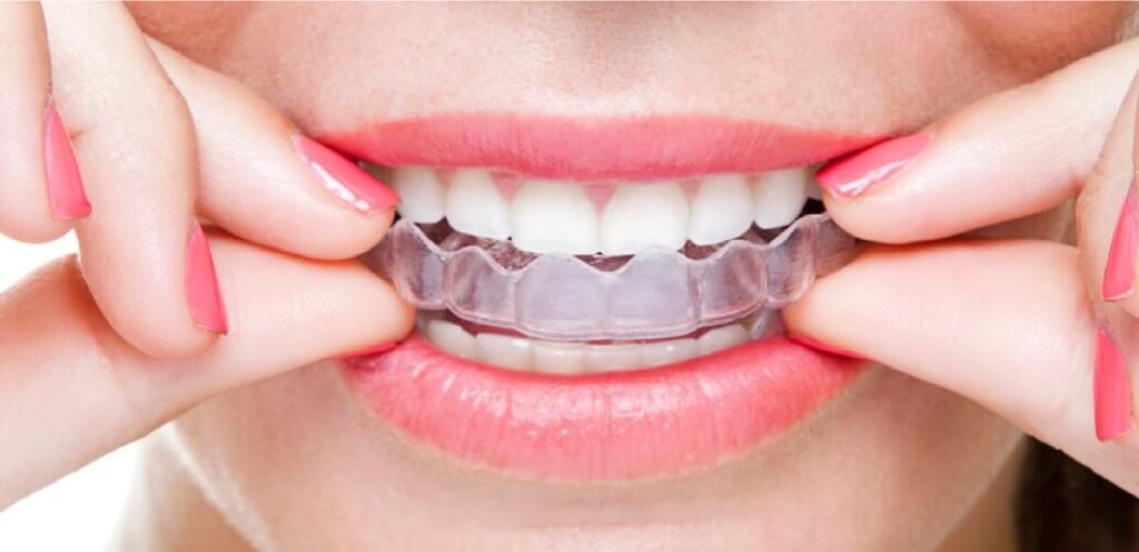 Invisalign retainers