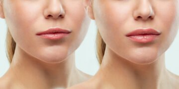 Lip Fillers