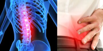 Spinal Stenosis