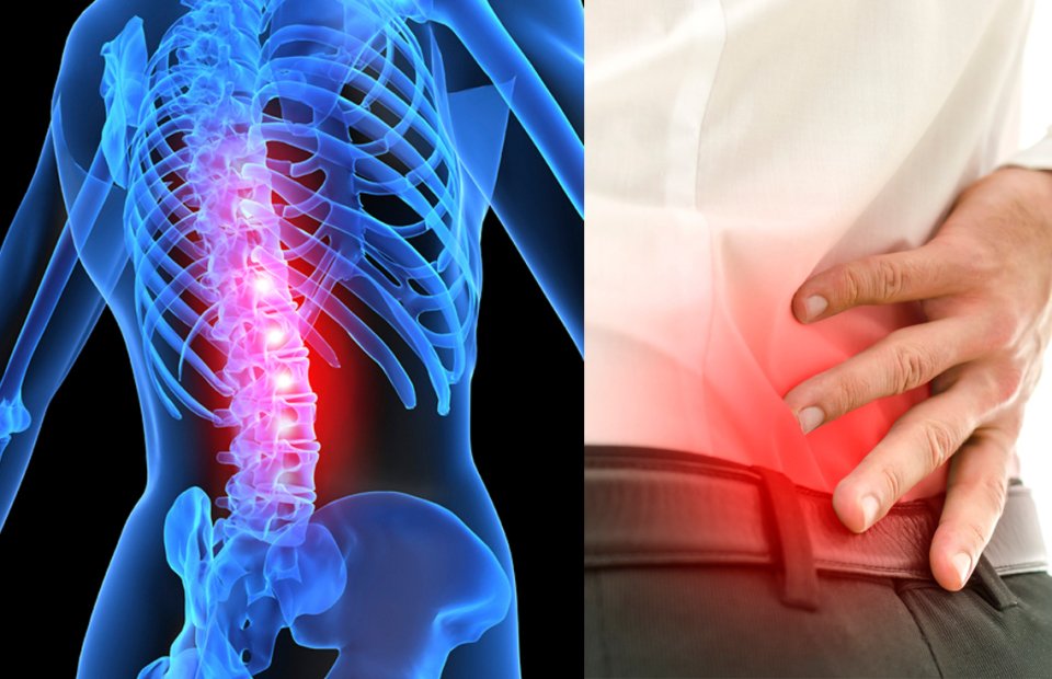 Spinal Stenosis