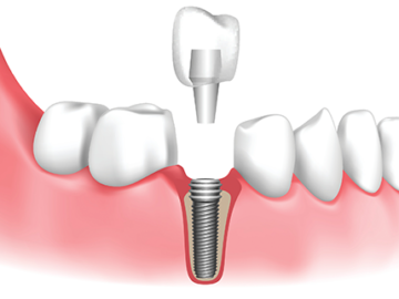 Dental Implants