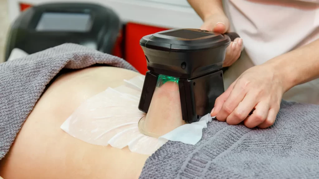 CoolSculpting