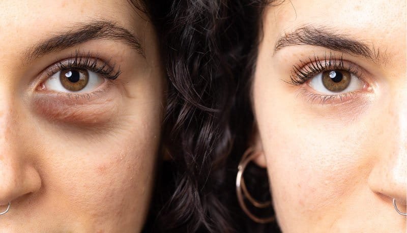 Dark Eye Circle Treatment Singapore