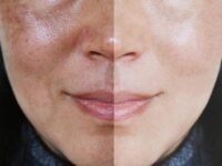 Melasma Treatment