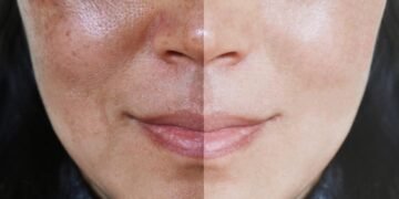 Melasma Treatment