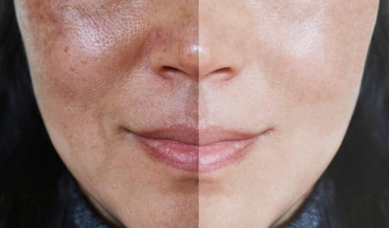 Melasma Treatment Singapore: What to Avoid for the Best Results