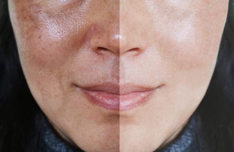 Melasma Treatment