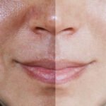 Pigmentation and Melasma