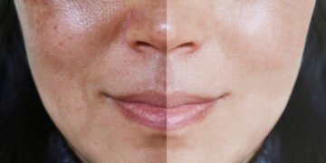 Pigmentation and Melasma