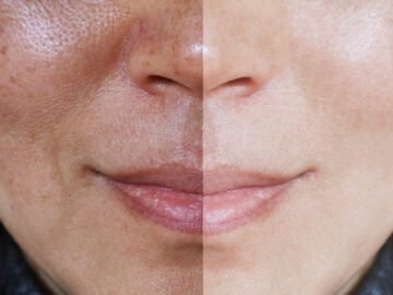 Pigmentation and Melasma