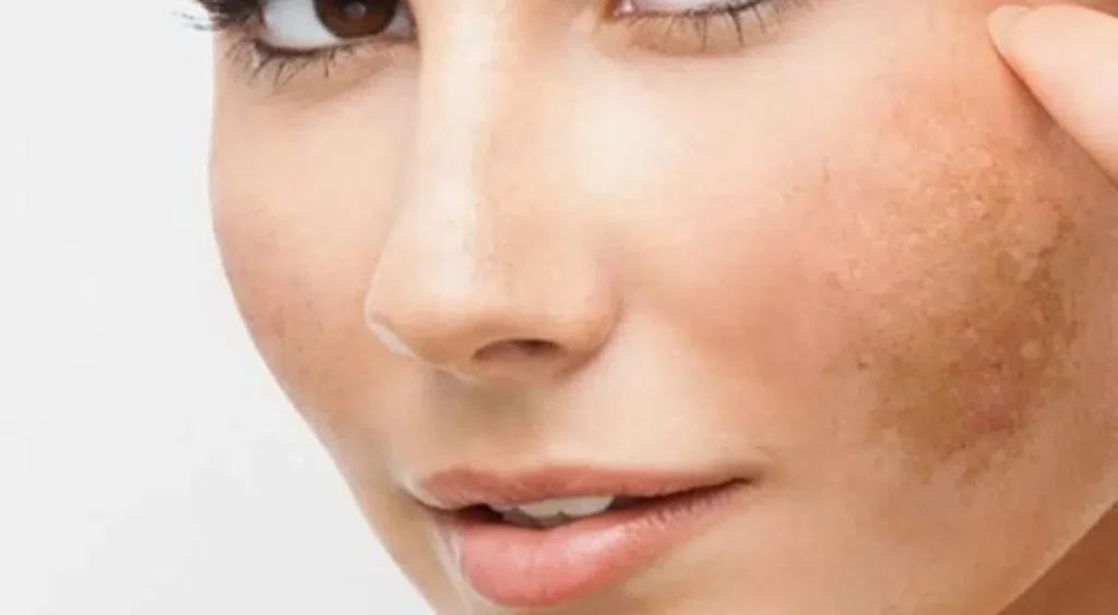 Tell-Tale Signs of Melasma
