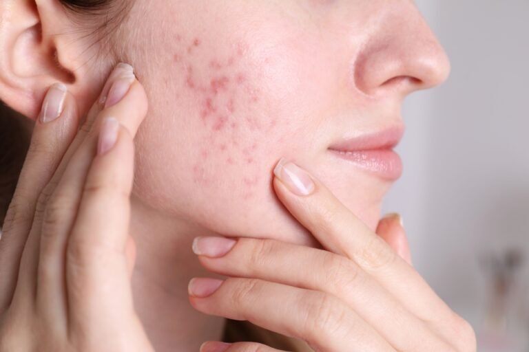 Active Acne