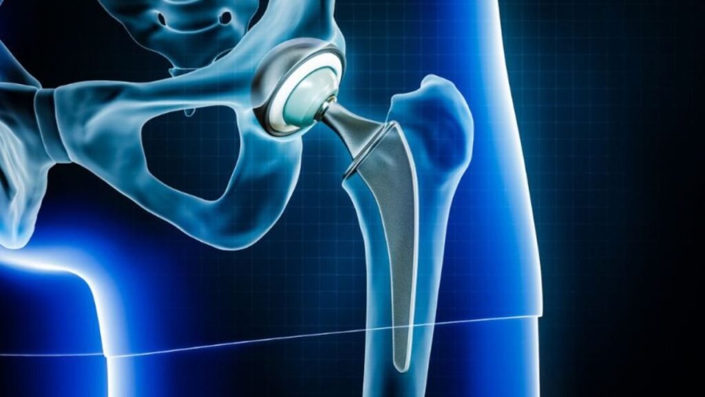 hip replacement