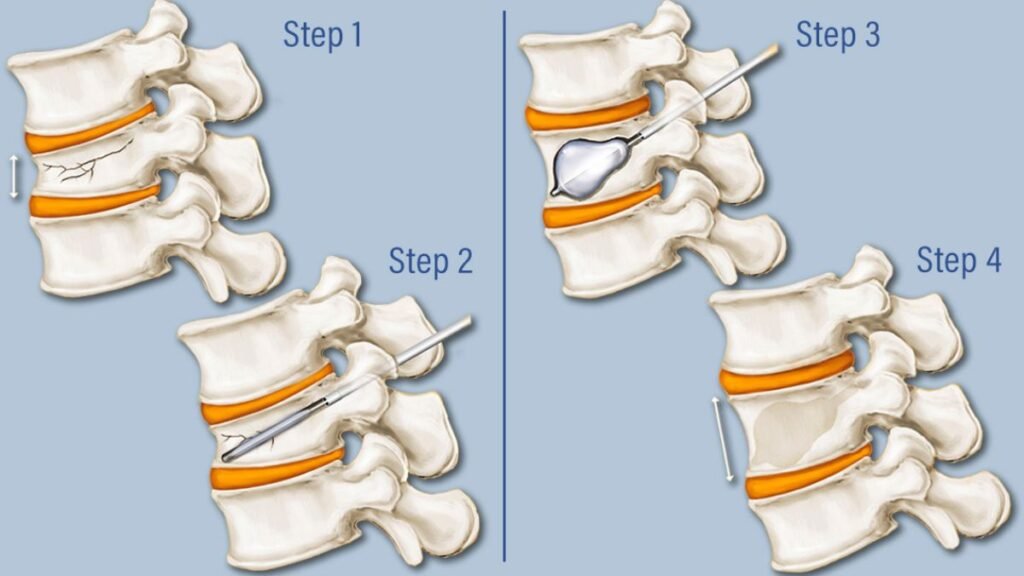 Kyphoplasty