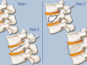 Kyphoplasty