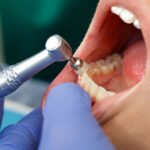 Routine Dental Cleaning