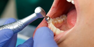 Routine Dental Cleaning