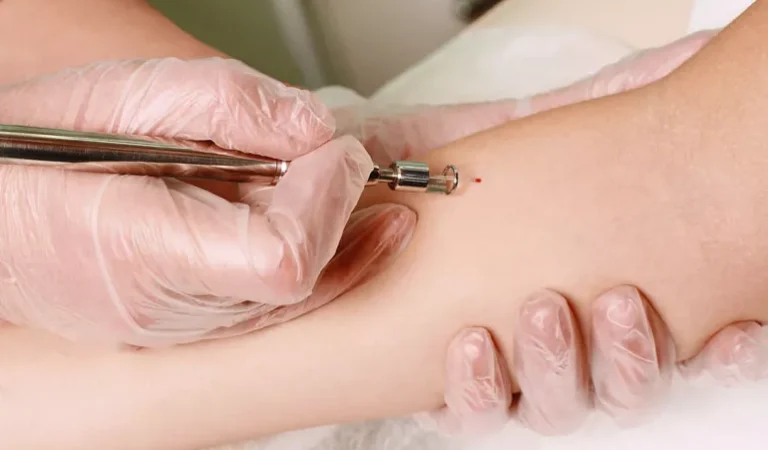 Understanding Mohs Surgery: A Comprehensive Guide to Skin Cancer Treatment
