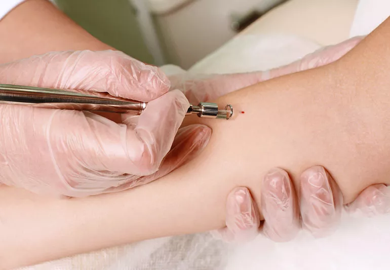 Mohs Surgery