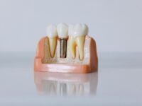 Implants