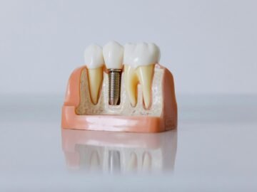 Implants