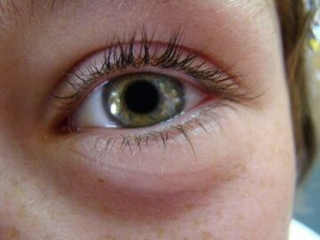 Cocaine Pupils