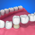 Dental Bridges