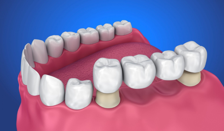 What are the Types of Dental Bridges? Which One is Right for You?