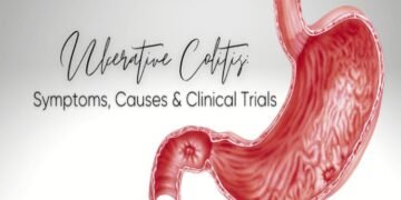 Ulcerative Colitis Clinical Trials