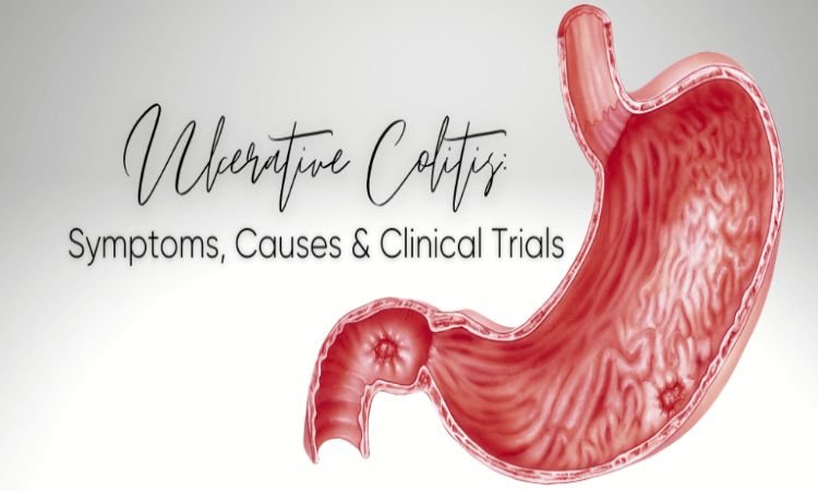 Best Practices for Ulcerative Colitis Clinical Trials