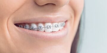 Metal Braces