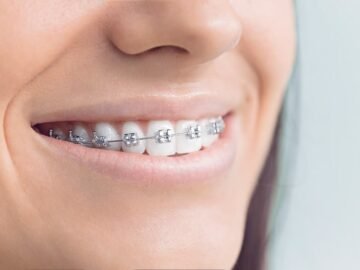 Metal Braces