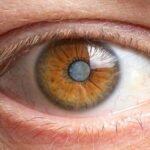 Cataracts