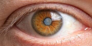 Cataracts