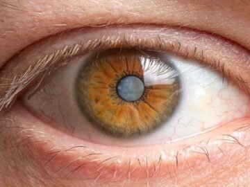 Cataracts