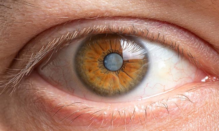 How Cataracts Develop with Age: What You Should Know