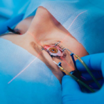 LASIK Eye Surgery