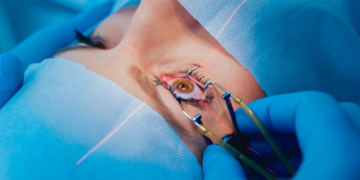 LASIK Eye Surgery