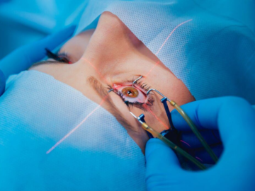 LASIK Eye Surgery
