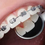 Choosing Braces
