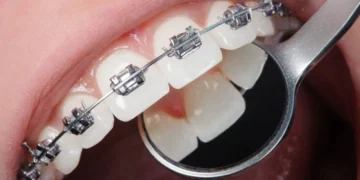 Choosing Braces