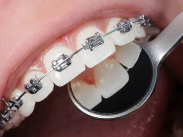Choosing Braces
