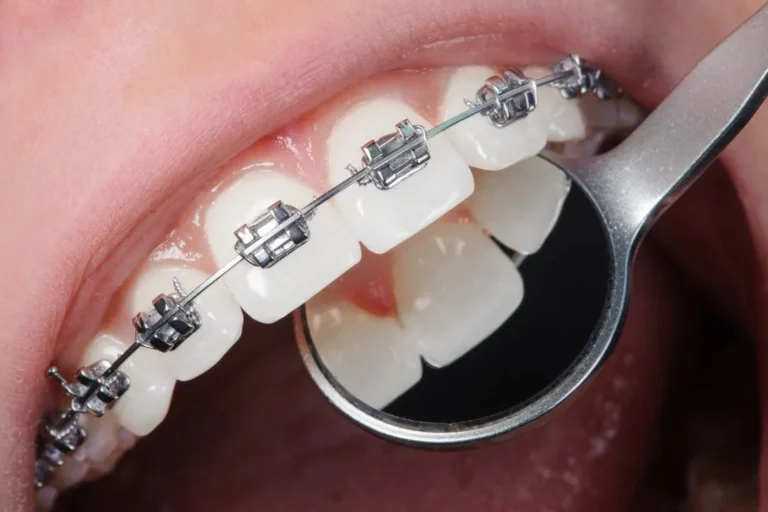 Choosing Braces