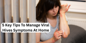 Viral Hives