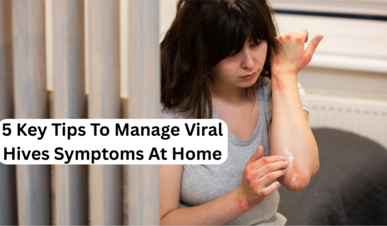 5 Key Tips To Manage Viral Hives Symptoms At Home