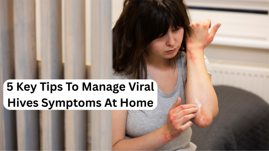 Viral Hives